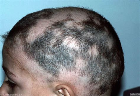 Alopecia areata causes, symptoms and best treatment for alopecia areata