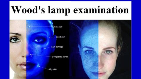 Wood's lamp examination - YouTube