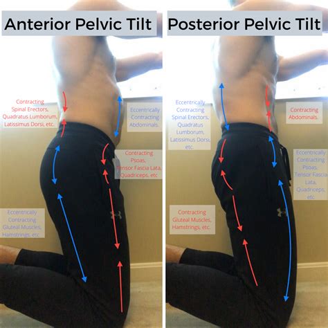 how to fix anterior pelvic tilt - Altagracia Defir