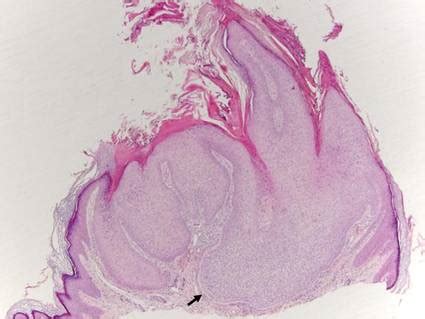 Trichilemmoma | MDedge Dermatology