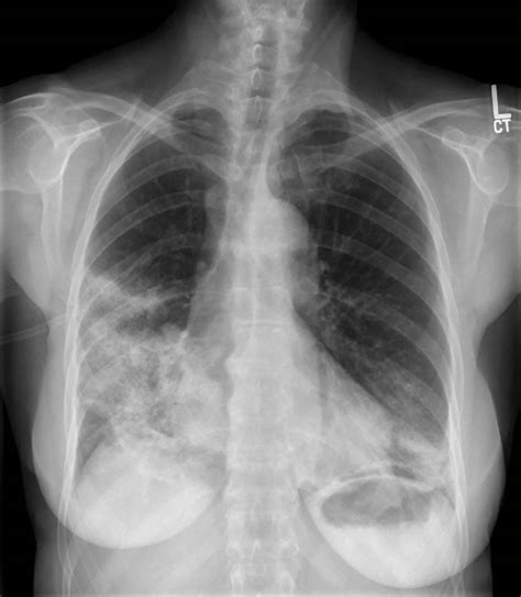 Popcorn lung causes, symptoms, diagnosis, treatment & prognosis