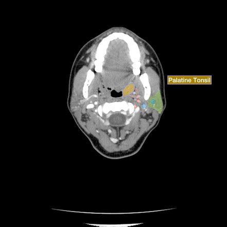 Tonsillectomy Anatomy