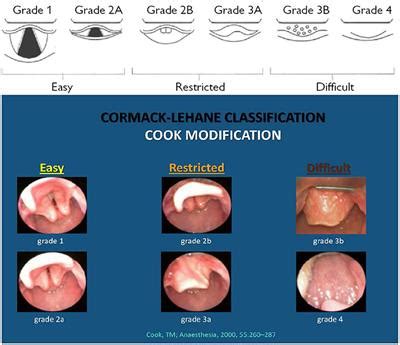 Frontiers | Management of the Unexpected Difficult Airway in Neonatal Resuscitation