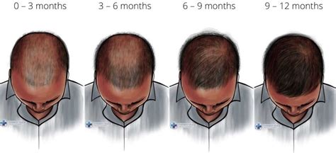 Discover more than 79 finasteride hair regrowth best - in.eteachers