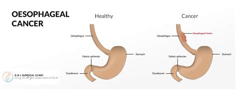 Oesophageal Cancer Treatment | Oesophageal Cancer Surgery Singapore