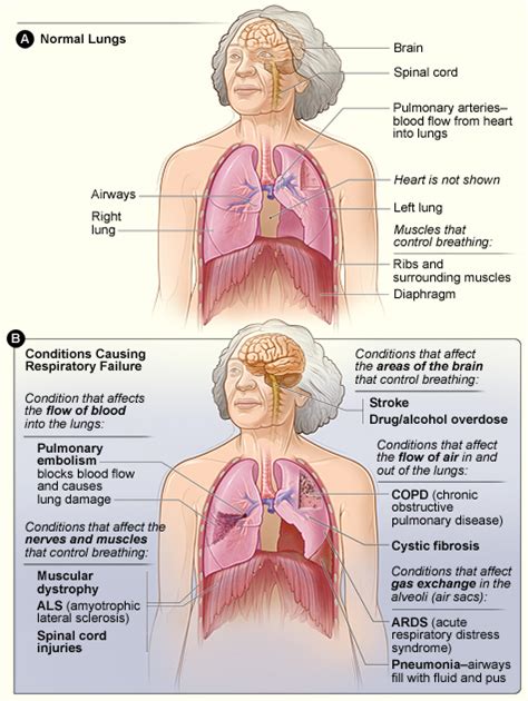 Respiratory Failure - Physiopedia