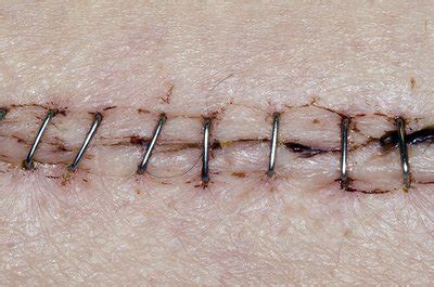 Stapled wound - Stock Image - C016/9310 - Science Photo Library