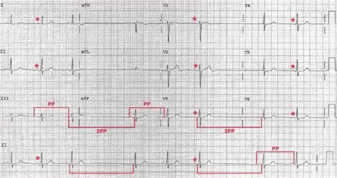 ECG Case 118: Sinus Node Exit Block - Manual of Medicine