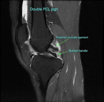 Bucket-handle meniscal tear | Radiology Reference Article | Radiopaedia.org