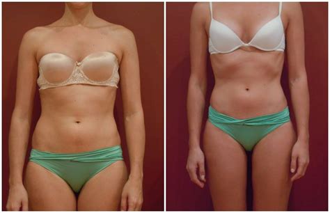 CHECK-OUT THIS BIKINI BODY BEFORE AND AFTER FROM HYPOXI - Wedded Wonderland