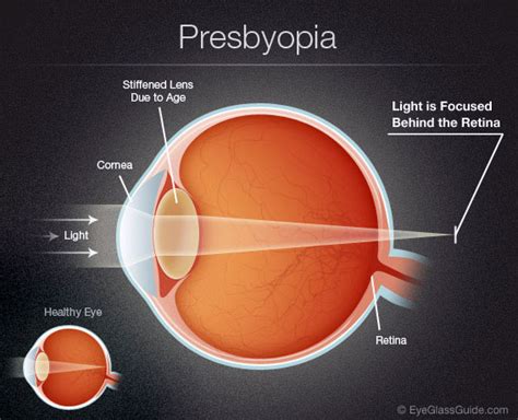 Presbyopia causes, symptoms & treatments | Assil Gaur Eye