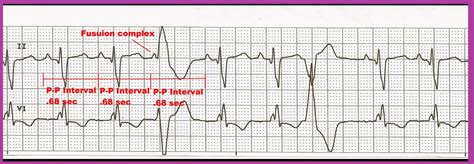 Float Nurse: Ventricular Escape Beats and Fusion Beats with Interpretation by Dr Ken Grauer, MD