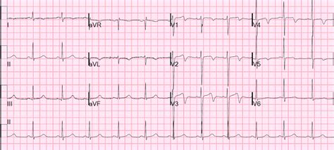 Dr. Smith's ECG Blog: Wellens' waves are NOT equivalent to Wellens' syndrome: Pseudo-Wellens ...