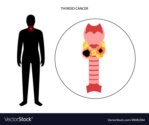 Thyroid cancer stages Royalty Free Vector Image