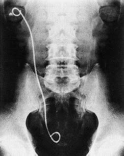 Kidney Stent - Side Effects and Complications - Kidney Stent