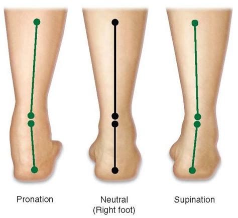 Pioneer Podiatry - Flat Feet, Collapsing Arches, Over-Pronation & High ...