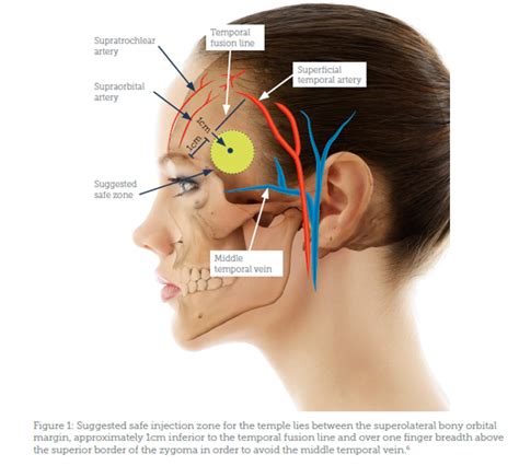 Treating Hollow Temples with Filler - Aesthetics