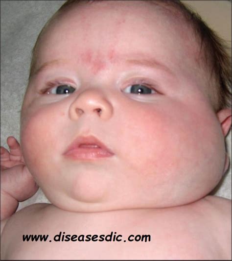 Cystic Hygroma or Cystic Lymphangioma – Causes and Prevention.