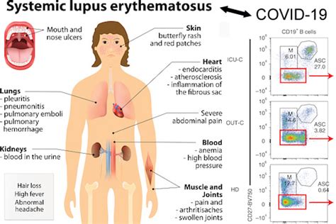 Immune cell activation in severe COVID-19 resembles lupus