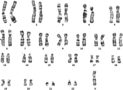 Sindrome De Turner Cromosoma