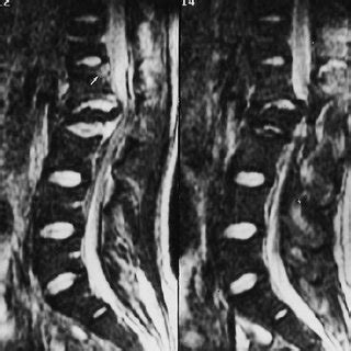 Case 1. CT scans demonstrating the C4 sagittal body fracture with ...