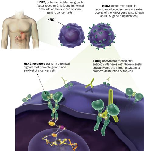 Medical Illustration: Targeting HER2 in Gastric Cancer