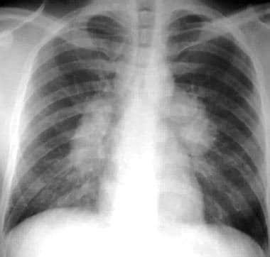 Thoracic (Pulmonary) Sarcoidosis Imaging: Practice Essentials, Radiography, Computed Tomography