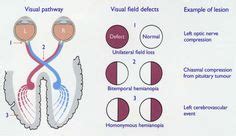 HEMIANOPSIA BITEMPORAL PDF