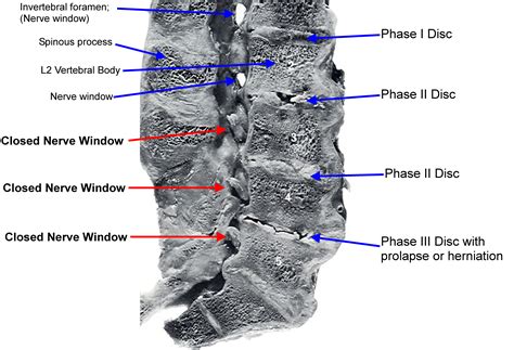 L4 L5 S1 Dermatomes