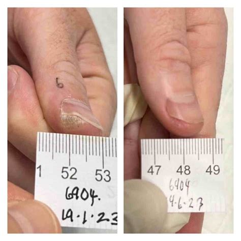 Wart Removal Sydney | Swift Plantar Wart Removal