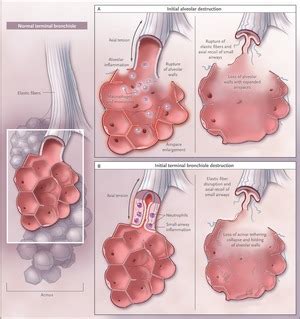 Emphysema — A Disease of Small Airways or Lung Parenchyma? | NEJM