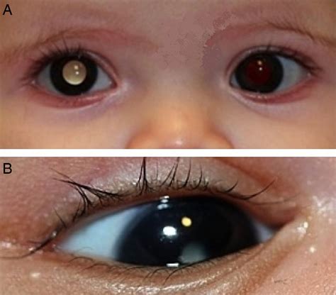 Eye disorders in newborn infants (excluding retinopathy of prematurity) | ADC Fetal & Neonatal ...