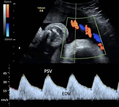 Frontiers Umbilical Artery Thrombosis And Maternal Positive, 48% OFF