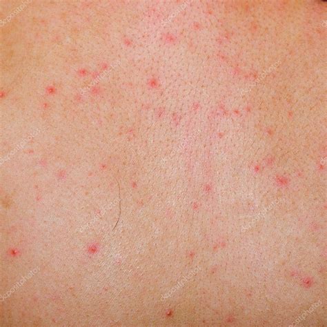 Allergic rash dermatitis skin — Stock Photo © panxunbin #6926399