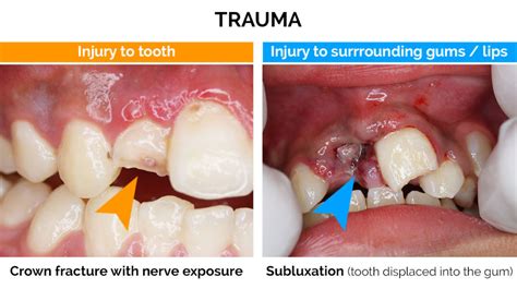 Dental Trauma - Oralcare