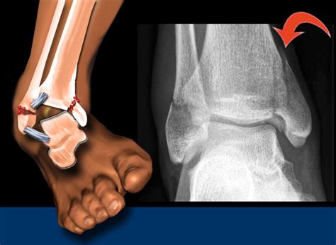 Weber Classification Ankle Fracture