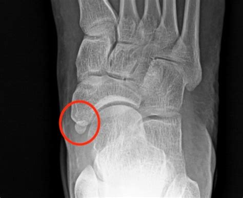 Accessory Navicular Bone