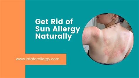 How Do You Get Rid of Sun Allergy Naturally?