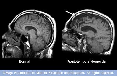 Healthy Female Brain Mri