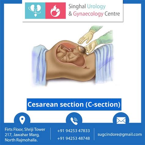 Beautiful Moments of Cesarean Section (C-section) Surgery