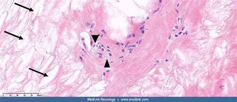 Tendinous Xanthoma Histology