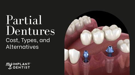 Partial Dentures - Cost, Types and Alternatives