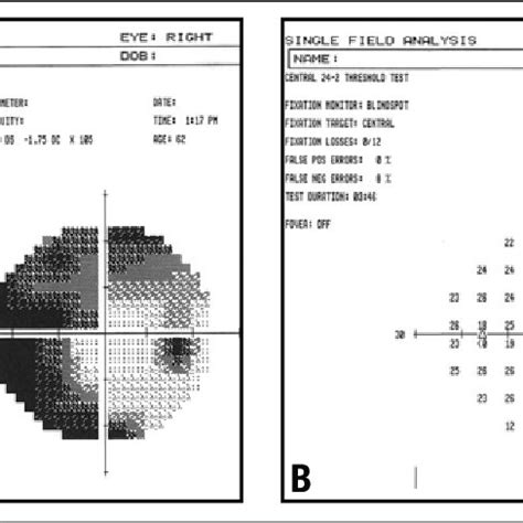 OCT of the RNFL six weeks following recurrence of NAION in right eye.... | Download Scientific ...