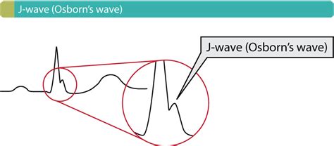 J-Wellen-Syndrome im EKG: Hypothermie, frühe Repolarisation (early ...