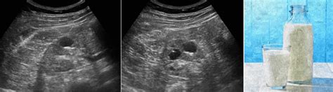 Milk Of Calcium Cyst Ultrasound