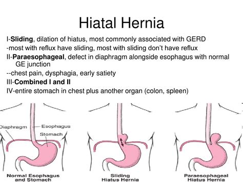 Esophagus Hiatal Hernia Surgery