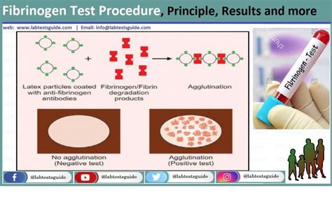 Fibrinogen Test Procedure | Lab Tests Guide