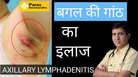 बगल की गाँठ - Axillary Lymphadenitis | Armpit Lymph Nodes Swollen | Swollen Lymph Nodes ...