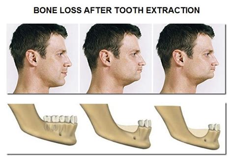 Dental Implants Replace Missing Teeth | Dental Implant Pasadena