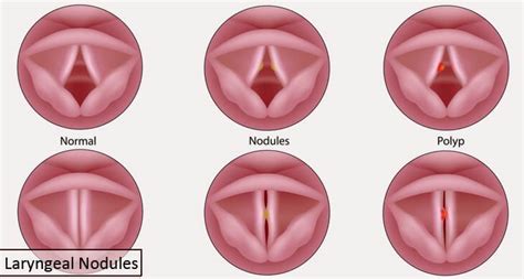 Larynx Definition and Information about its Parts, Function & Diseases